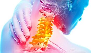 Signos de osteocondrose da columna cervical