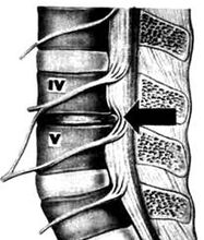 Imaxe x -ray do departamento lumbar de osteocondrose