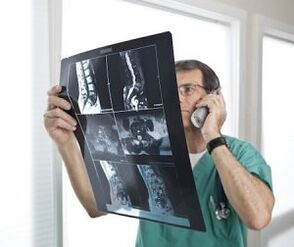 Mielografía para o diagnóstico de osteocondrose e hernias intervertebrais