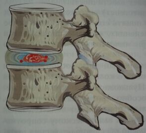Primeira fase da osteocondrose