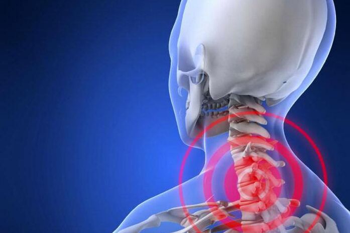 A dor punzante no pescozo é un síntoma precoz da osteocondrose cervical